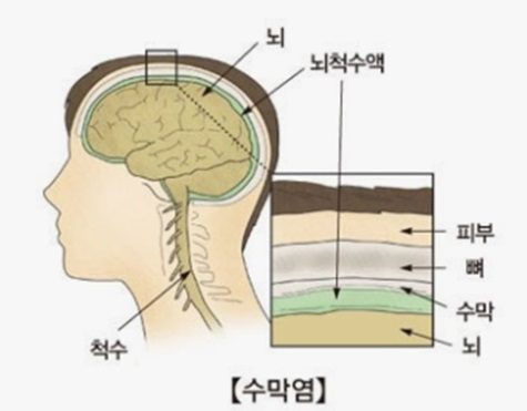 뇌수막염